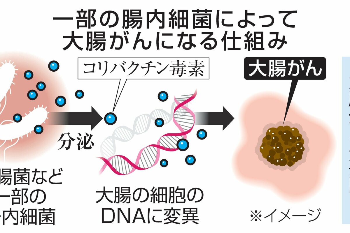 日本人の大腸がん、5割が腸内細菌に原因か 他国平均の2・6倍、若年患者