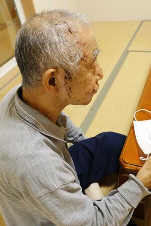 クマに顔や頭をかまれた猟友会の奥村勉さん＝新発田市