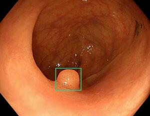AIを使った大腸検査の補助システムの画面。ポリープと思われる部分を四角で囲って医師に示す(森悠一オスロ大教授提供)