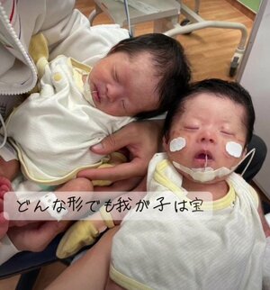 小さな体で様々な治療を乗り越えている双子ちゃん