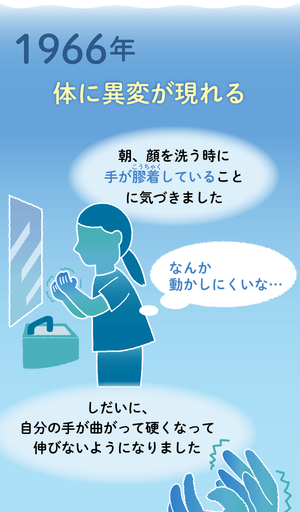 1966年:体に異変が現れました。朝、顔を洗う時に手が膠着していることに気づきました。しだいに、自分の手が曲がって硬くなって伸びないようになりました。