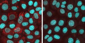　細胞内にタンパク質「ＴＤＰ４３」の凝集体（赤色）が蓄積している状態（左）と、細胞に化合物を入れて凝集体の形成を抑えた様子（奈良県立医大、モルミル提供）