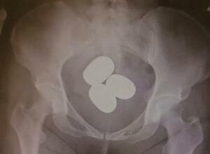 　東京税関成田税関支署が公表した、香港からの旅客が体内に粉状の金を隠し密輸しようとした摘発事例（同署提供）