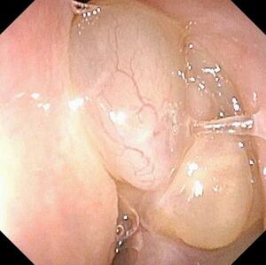 内視鏡で見た好酸球性副鼻腔炎患者の鼻茸(中央や右下の丸く膨らんだ部分)(福井大病院提供)